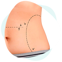 procedimentos-e-cirurgias-abdominoplastia