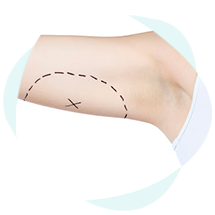 procedimentos-e-cirurgias-braquioplastia