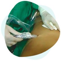 procedimentos-e-cirurgias-procedimento-de-lipoaspiracao