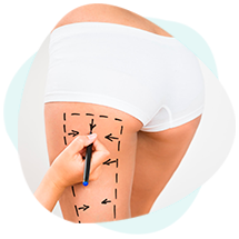 procedimentos-e-cirurgias-dermolipectomia-de-coxas
