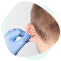 procedimentos-e-cirurgias-otoplastia